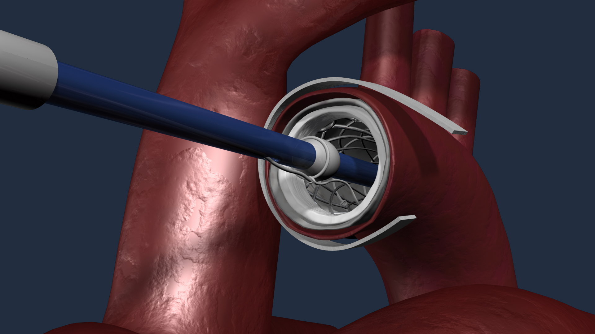 Dissection Stent - Medical animation